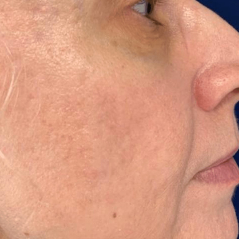 Genius After Treatment